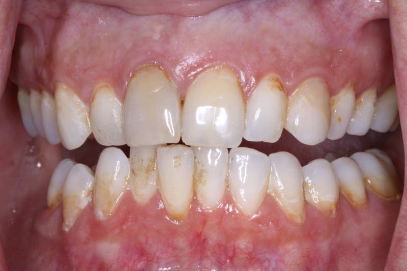 before invisalign treatment - belmont dentistry