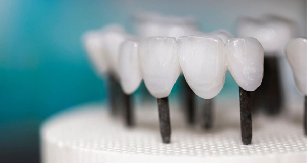 dental veneers in peoria az at belmont dentistry