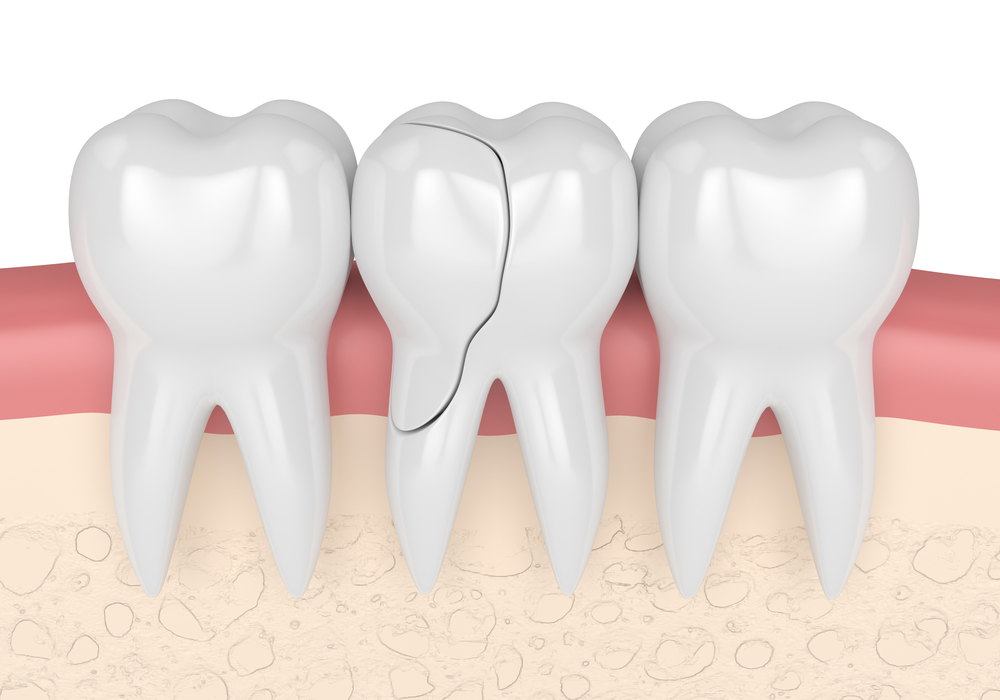 3d render of gums with treatable cracked tooth over white background. Fractured cusps. Different types of broken teeth concept.