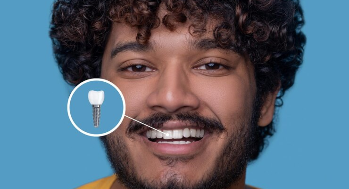 how to make your dental implants look amazing in 7 days