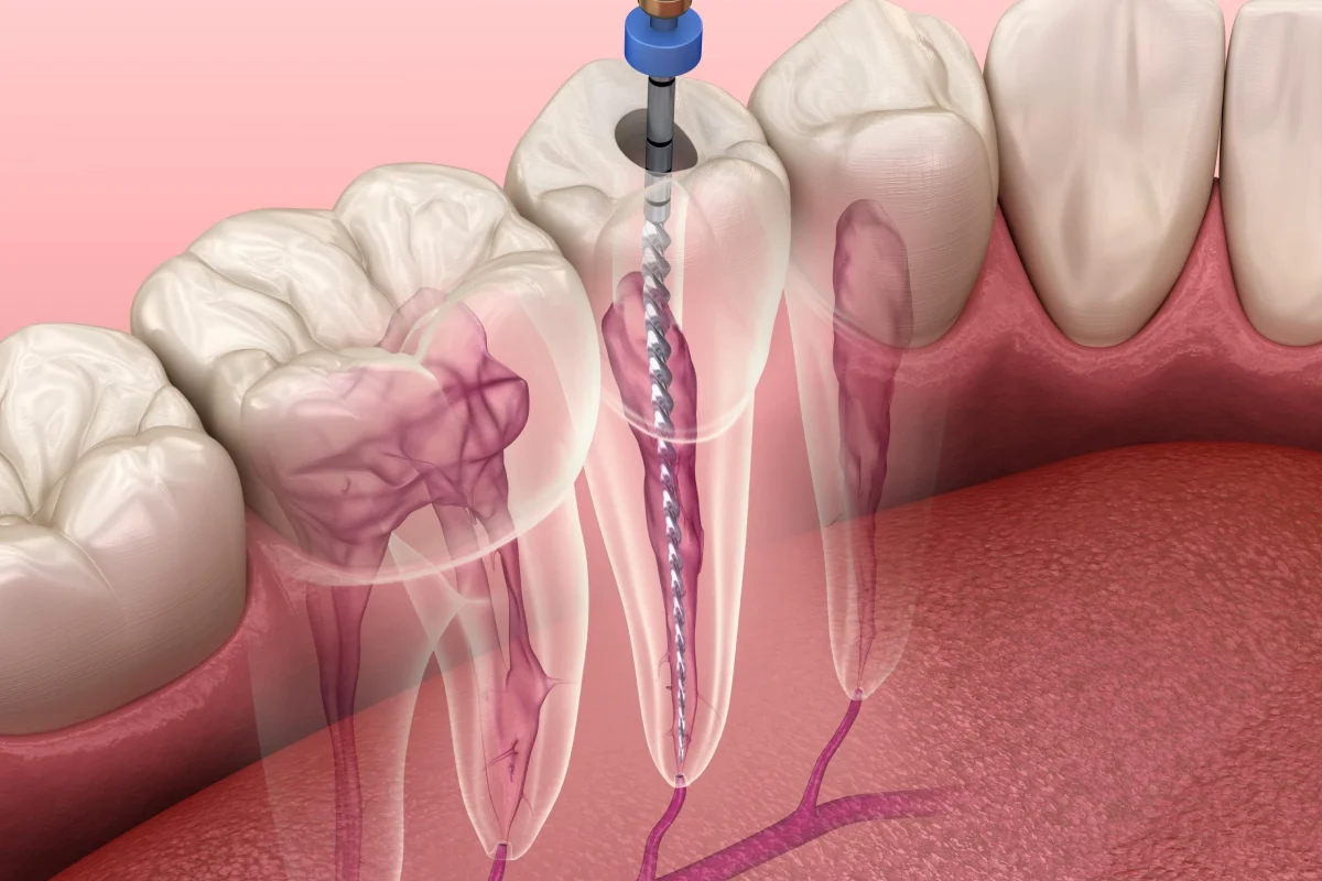 My Tooth Doesn’t Hurt