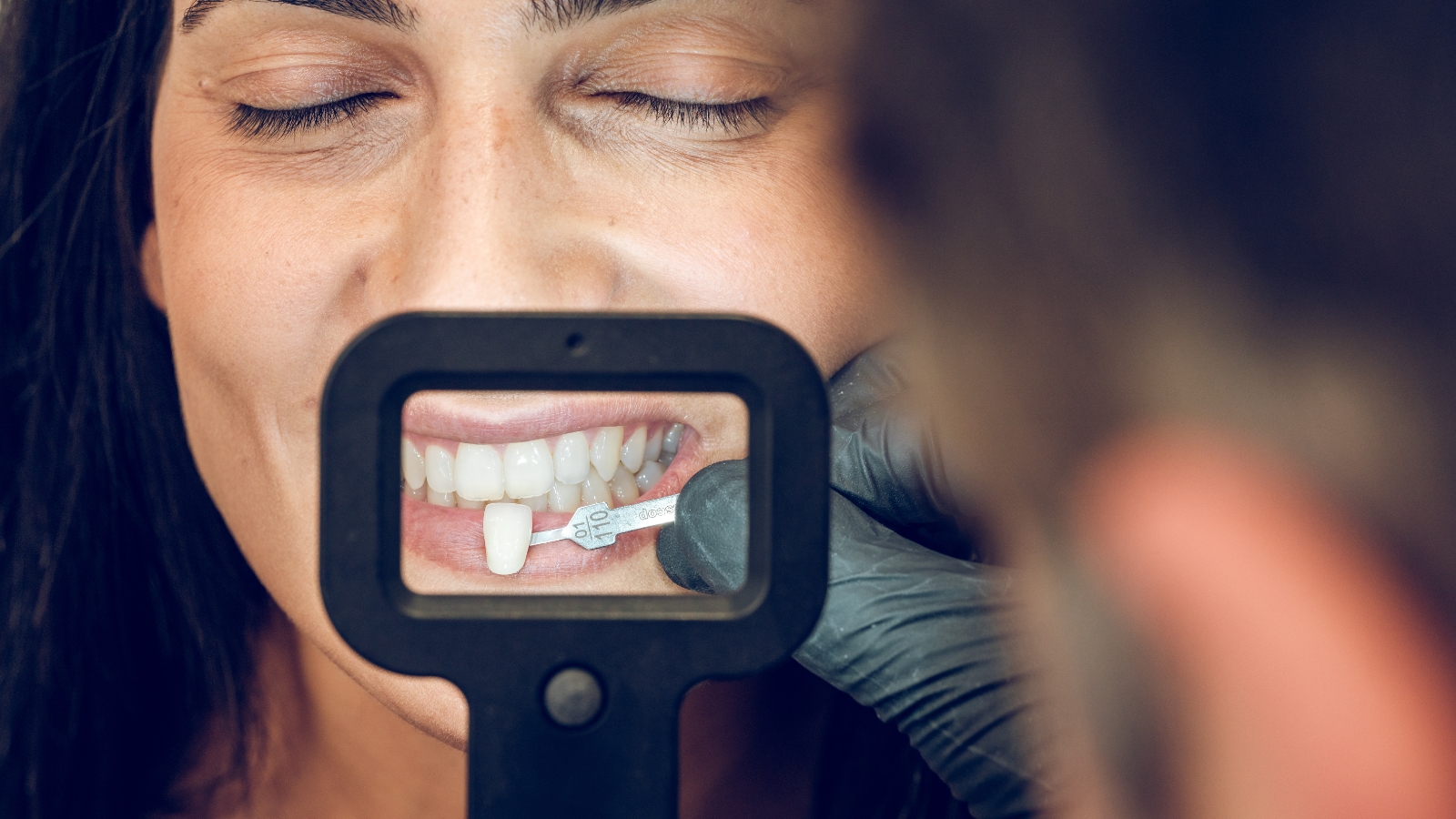 Veneers Change Your Smile