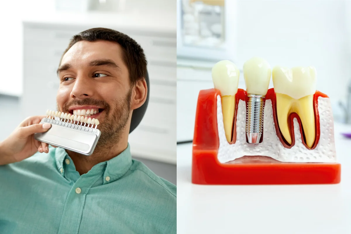 Veneers vs. Implants