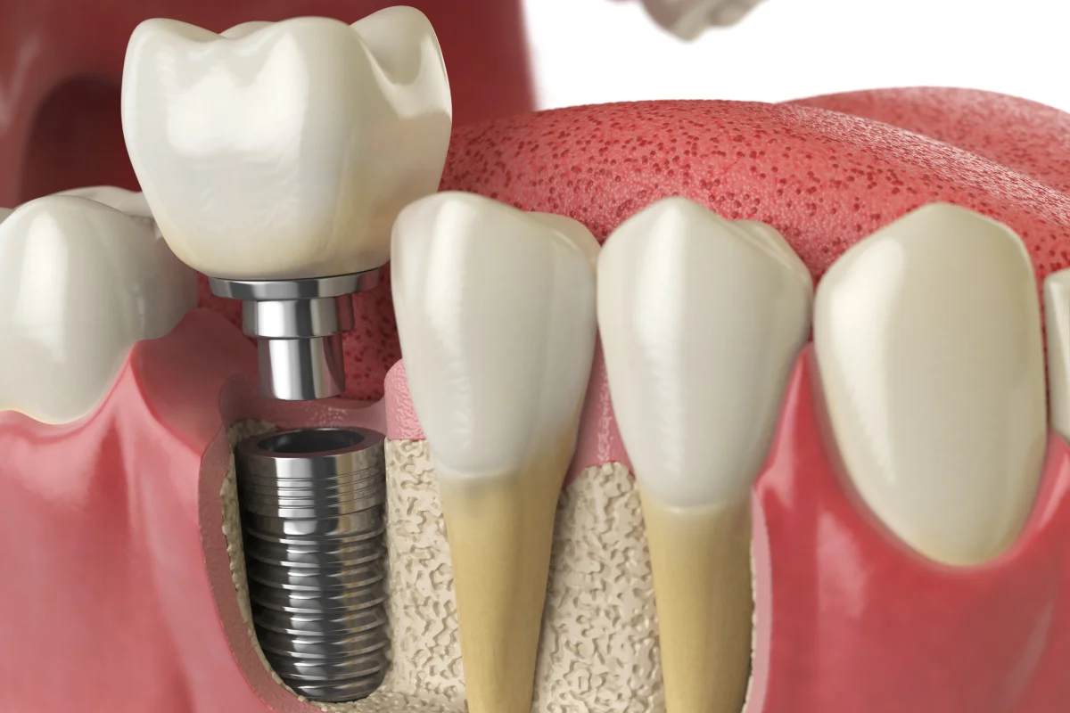 Phoenix’s Dental Implant Recovery Process