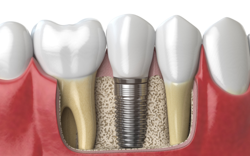 5 Signs You’re Ready For Dental Implants
