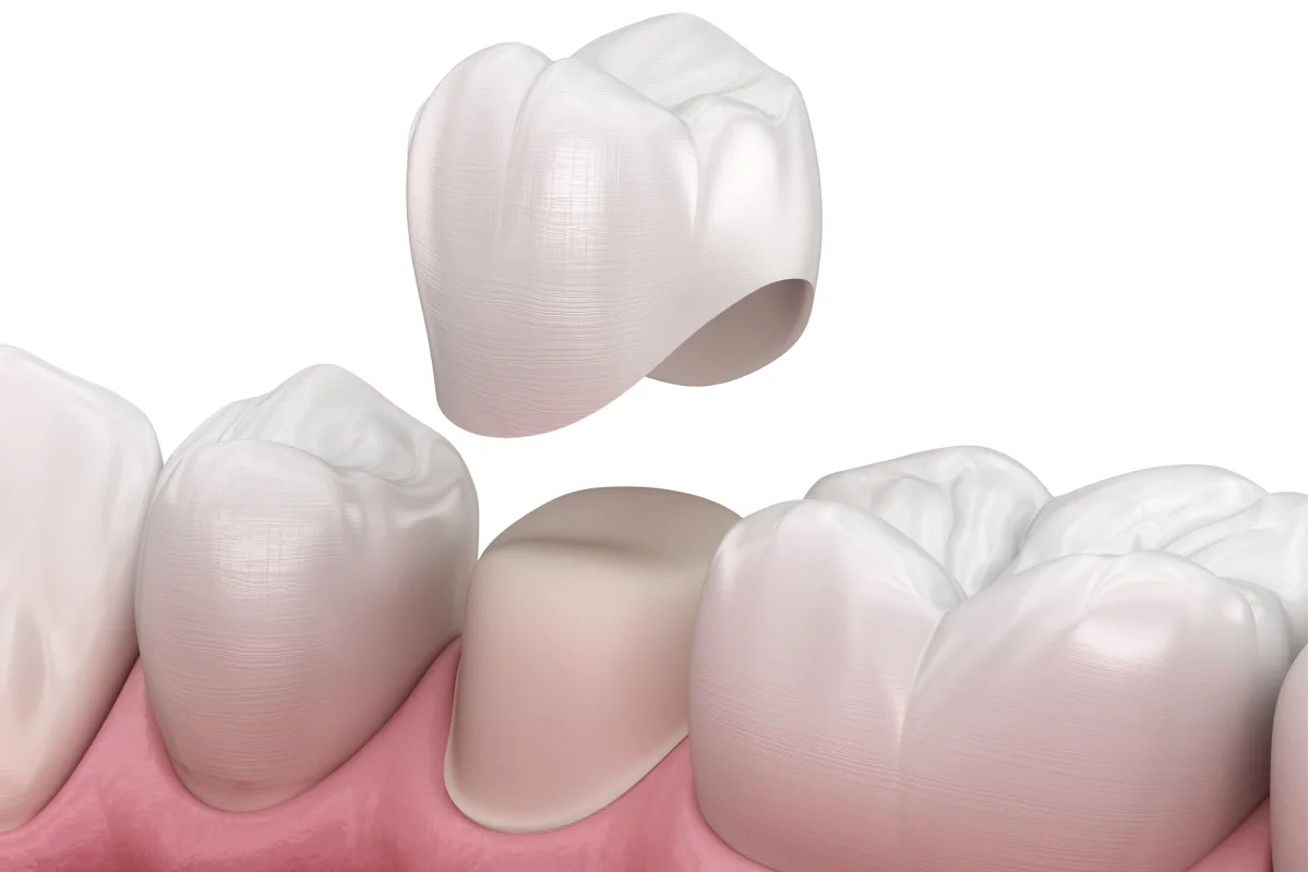Crowns vs. Fillings