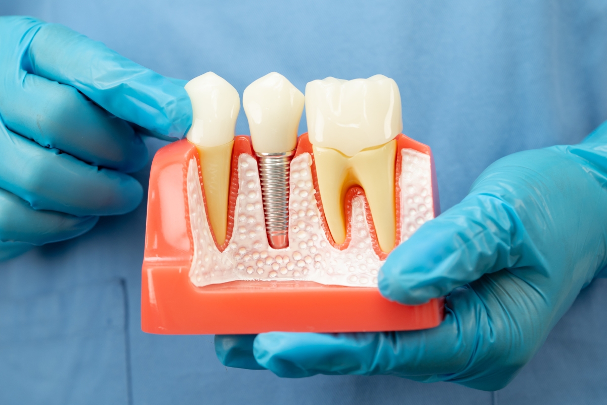 dental implants in Scottsdale