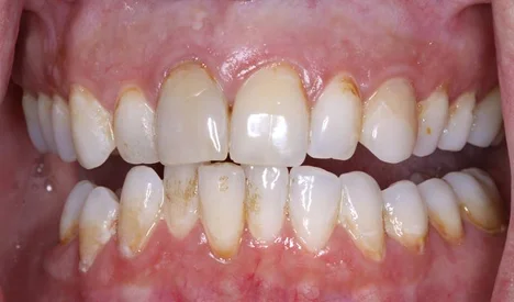 teeth-whitening-before