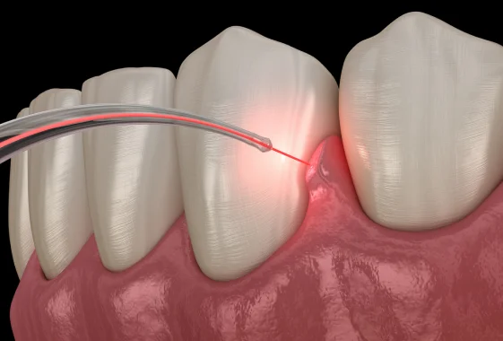 Laser treatment targeting gum tissue around teeth